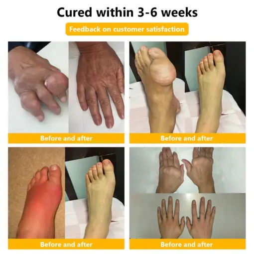 𝐒𝐓𝐃𝐄𝐈®𝐁𝐨𝐭𝐮𝐥𝐢𝐧𝐮𝐦 𝐓𝐨𝐱𝐢𝐧 & 𝐁𝐞𝐞 𝐕𝐞𝐧𝐨𝐦 𝐏𝐚𝐢𝐧-𝐑𝐞𝐥𝐢𝐞𝐟 𝐁𝐨𝐧𝐞 𝐇𝐞𝐚𝐥𝐢𝐧𝐠 𝐂𝐫𝐞𝐚𝐦