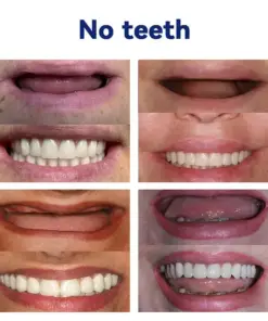 TAILEDEN™-New Generation Flexible Full Denture Solution