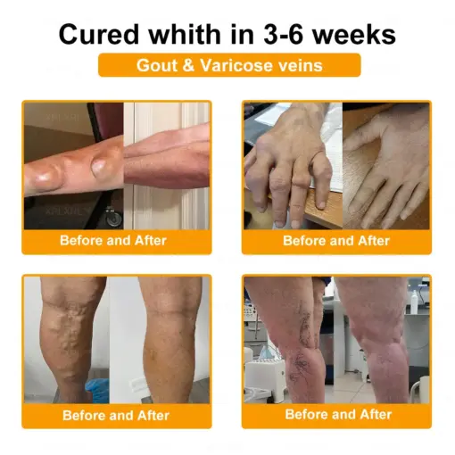 XRLXRL™ Bee Venom Pain-Relief Bone Healing Cream