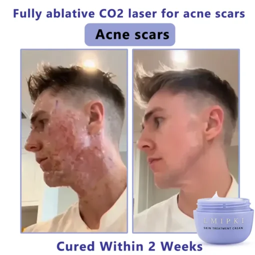 𝐋𝐦𝐢𝐩𝐤𝐢® 𝐒𝐤𝐢𝐧 𝐓𝐫𝐞𝐚𝐭𝐦𝐞𝐧𝐭 𝐂𝐫𝐞𝐚𝐧