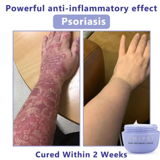 𝐋𝐦𝐢𝐩𝐤𝐢® 𝐒𝐤𝐢𝐧 𝐓𝐫𝐞𝐚𝐭𝐦𝐞𝐧𝐭 𝐂𝐫𝐞𝐚𝐧