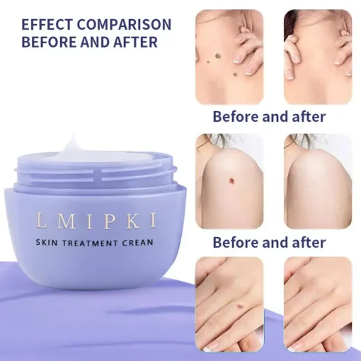 𝐋𝐦𝐢𝐩𝐤𝐢® 𝐒𝐤𝐢𝐧 𝐓𝐫𝐞𝐚𝐭𝐦𝐞𝐧𝐭 𝐂𝐫𝐞𝐚𝐧