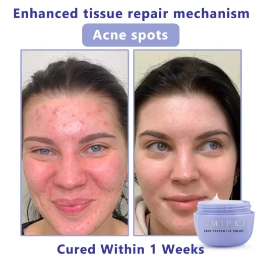 𝐋𝐦𝐢𝐩𝐤𝐢® 𝐒𝐤𝐢𝐧 𝐓𝐫𝐞𝐚𝐭𝐦𝐞𝐧𝐭 𝐂𝐫𝐞𝐚𝐧