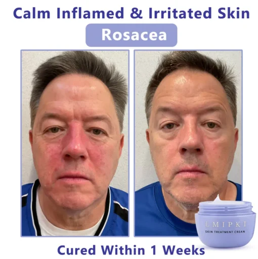 𝐋𝐦𝐢𝐩𝐤𝐢® 𝐒𝐤𝐢𝐧 𝐓𝐫𝐞𝐚𝐭𝐦𝐞𝐧𝐭 𝐂𝐫𝐞𝐚𝐧