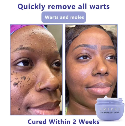 𝐋𝐦𝐢𝐩𝐤𝐢® 𝐒𝐤𝐢𝐧 𝐓𝐫𝐞𝐚𝐭𝐦𝐞𝐧𝐭 𝐂𝐫𝐞𝐚𝐧