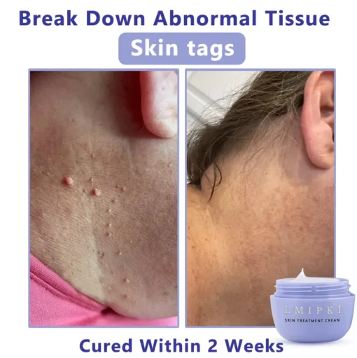 𝐋𝐦𝐢𝐩𝐤𝐢® 𝐒𝐤𝐢𝐧 𝐓𝐫𝐞𝐚𝐭𝐦𝐞𝐧𝐭 𝐂𝐫𝐞𝐚𝐧
